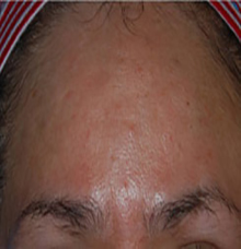 54-yr-blepharoplasty-laser-skin-resurfacing