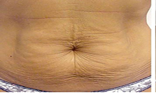 Abdomen-Sagging-Skin-Before-and-After-Treatment-5