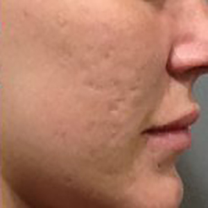 Microneedling-after