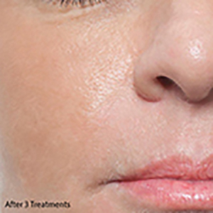 Microneedling-after_1