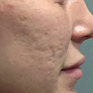 Microneedling-before