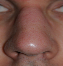 after-lasering-dermabrasion-nose-seattle