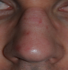 before-lasering-dermabrasion-nose-seattle