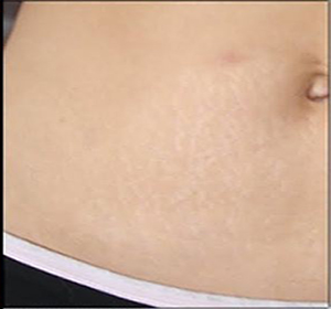 stomach_after_1