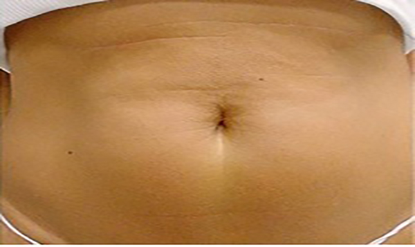 thermage-abdomen-treatment-after-1